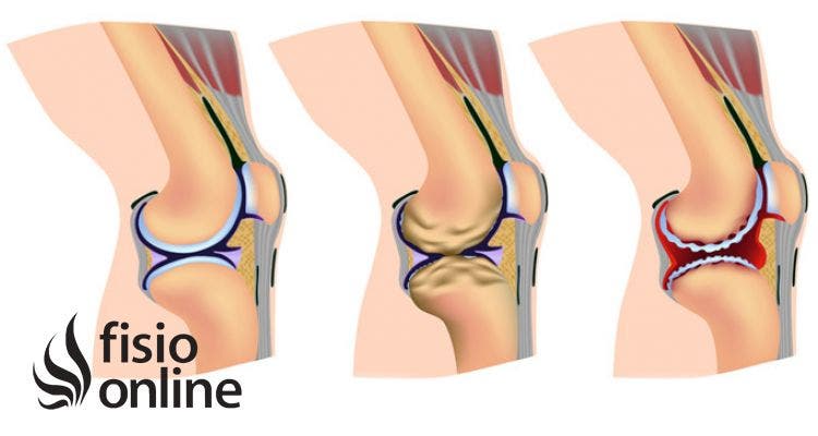 Artrosis o desgaste articular. Qué es, causas, síntomas y tratamiento quirúrgico y de fisioterapia