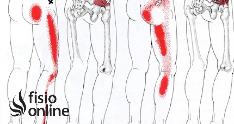 puntos desencadenantes del dolor pélvico