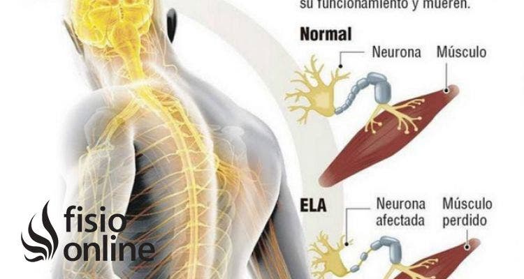 Esclerosis lateral amiotrófica. ¿Qué es? ¿Cómo tratar a un paciente con ELA? | Fisioterapia Online