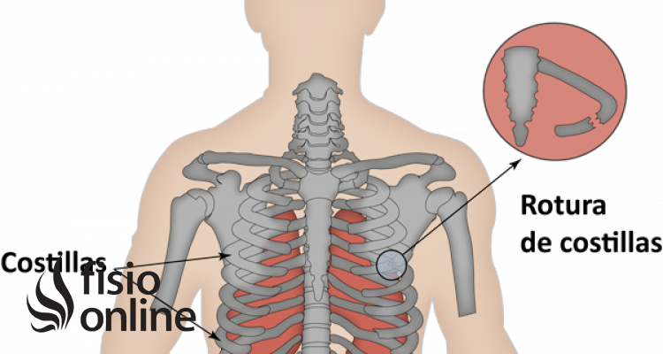 ¿Cómo se pueden disminuir las complicaciones ocasionadas por las fracturas de costillas?