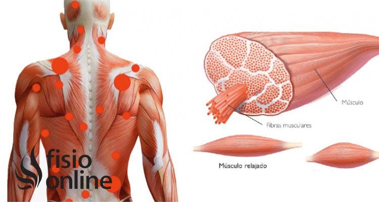 ¿Qué cambios debo hacer para evitar una contractura muscular de espalda?