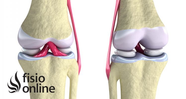 Rotura del ligamento cruzado anterior