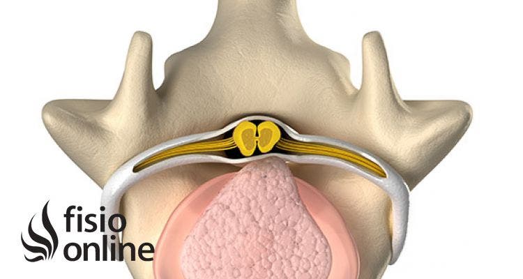 Un problema lumbar paradójico, pero muy frecuente