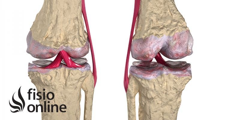 4 fokú artrosis a csípőízületen