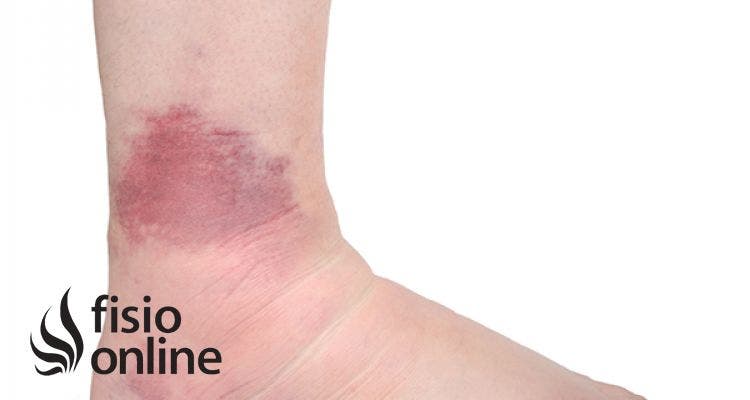 ESGUINCE FISIOTERAPIA esguince fisioterapia: