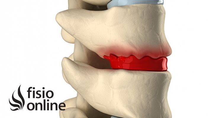 ¿Qué es la Degeneración del Disco Intervertebral?