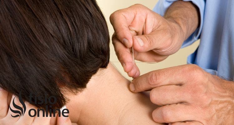 Punción seca en el tratamiento de la cefalea tensional