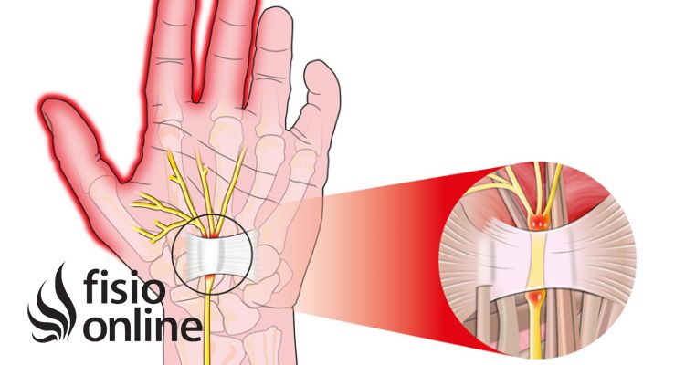 Sindrome del túnel carpiano. Ejercicios y tratamiento recomendado