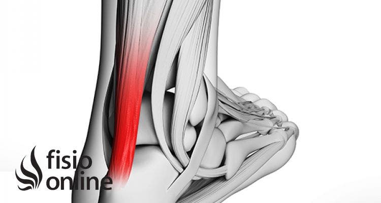 La Tendinitis en el deporte. Tipos, causas, y tratamiento