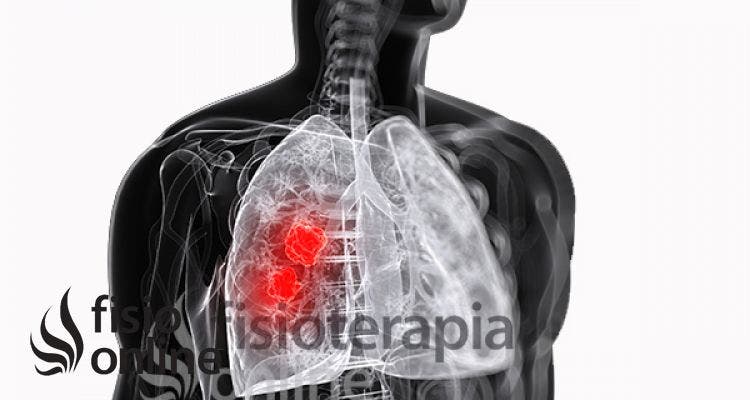 ¿Qué es un Absceso Pulmonar?