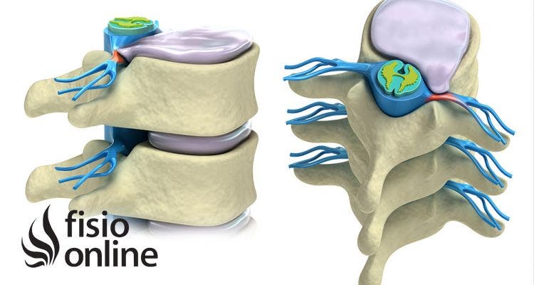 Hernias discales.