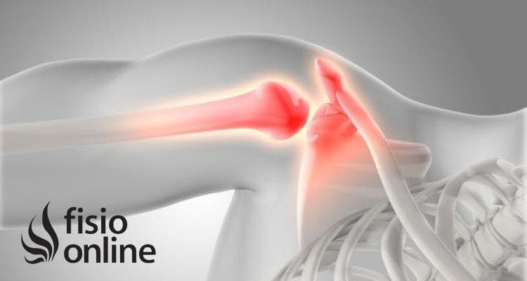 Bursitis, Tendinitis y Síndrome Subacromial: ¿Cómo Diferenciarlos y Tratarlos Correctamente?