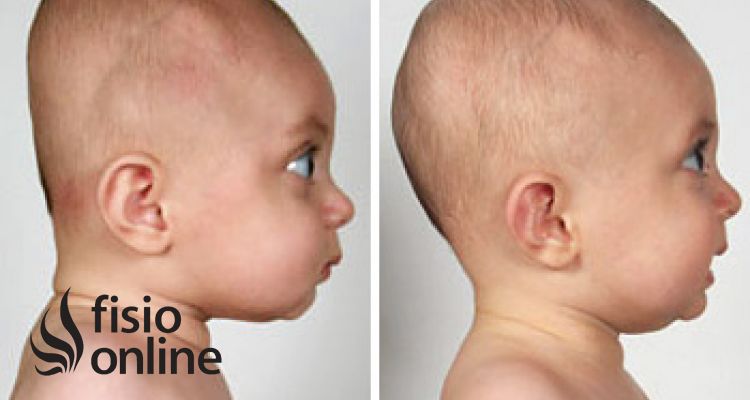 Plagiocefalia Y Torticolis En Bebes Recien Nacidos Fisioonline