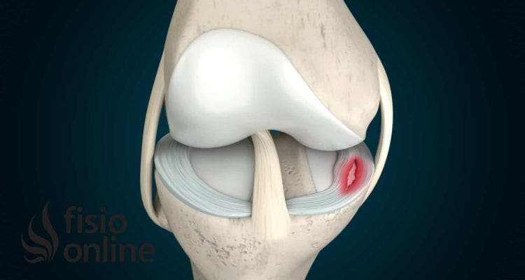 Diagnóstico de la rotura de menisco. Cómo saber si la padeces.