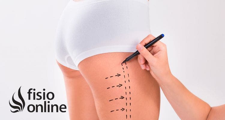 Abdominoplastía: 10 consejos para un postoperatorio exitoso