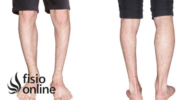 ¿Tienes una pierna más corta? Compensaciones musculares y cómo corregirlas