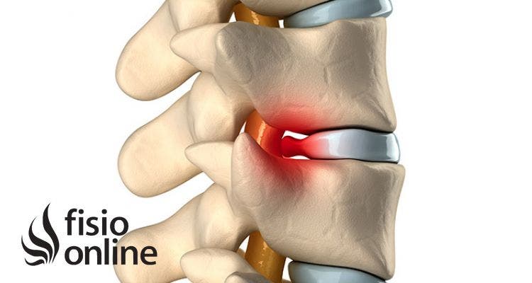 Qué Es Una Hernia Discal Lumbar Síntomas Causas Y Tratamiento