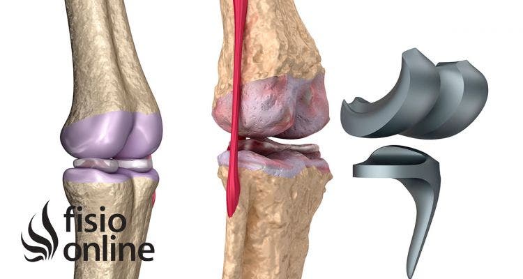 Rehabilitación de una prótesis de rodilla o artroplastia de rodilla. Consejos, ejercicios y fases de tratamiento