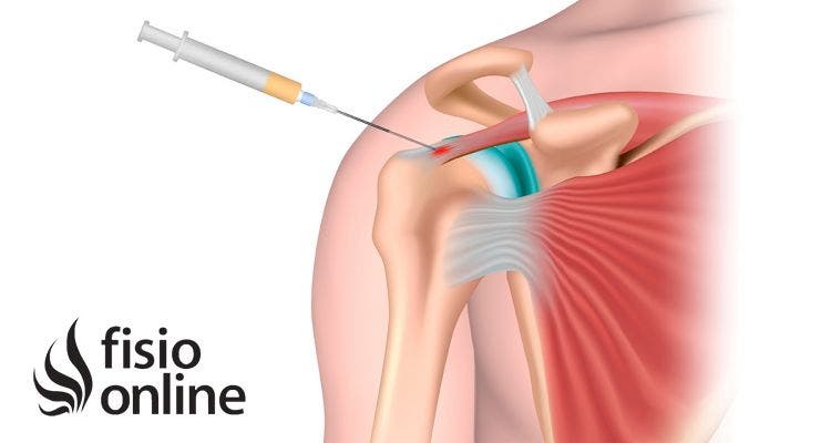 Beneficios del plasma rico en plaquetas en lesiones articulares, indicaciones, contraindicaciones y efectos terapéuticos