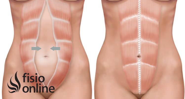 Embarazo: diástasis de los músculos rectos. Generalidades, prevención y tratamiento