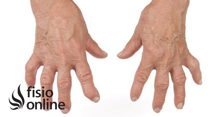 Artritis reumatoide. Qué es, fases y tratamiento médico y de fisioterapia