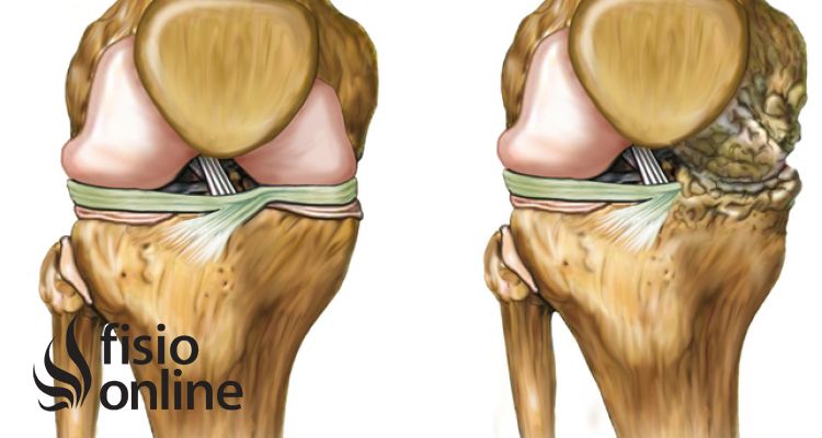 Artrosis en el deporte ¿Cómo cuidar nuestra rodilla? Prevención, tratamiento, alimentación y suplementos