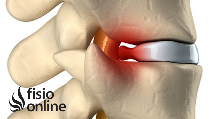 Tratamiento de hernia discal cervical  