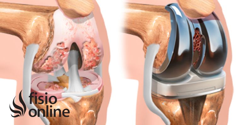 Cirugía de Protesis de Rodilla, Cómo se realiza la operación y cómo es su rehabilitación