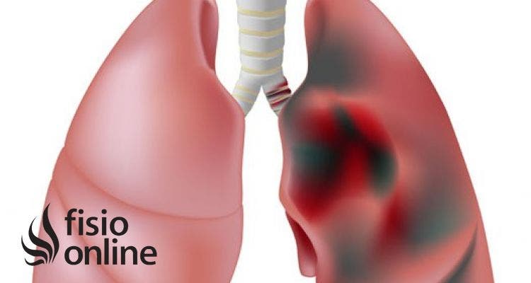 Enfermedad pulmonar obstructiva cronica o EPOC ¿Qué es?