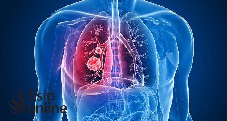 ¿Cómo se diagnostica la Fibrosis Quística?