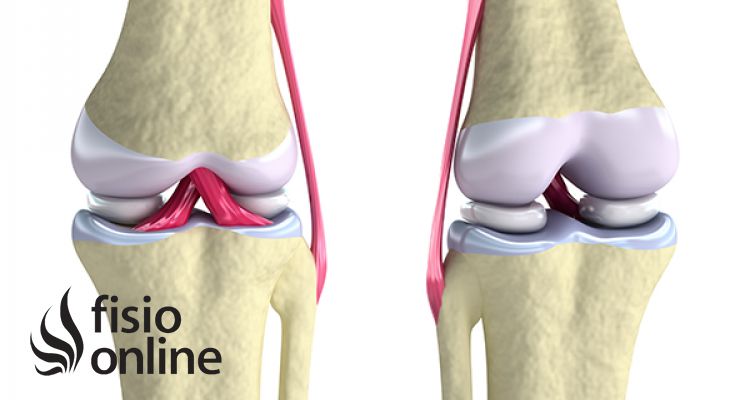 Rotura del ligamento cruzado anterior