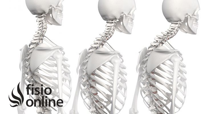 Alteración de la postura corporal (1ª parte)