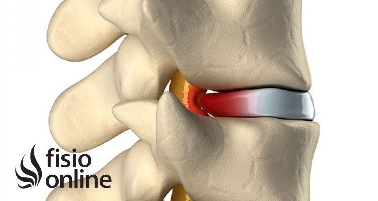 Hernia discal central a nivel L5-S. Causas, síntomas y tratamiento en fisioterapia