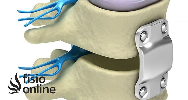 Artrodesis. Qué es, indicaciones, riesgos y ejercicios de fisioterapia