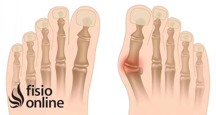 ¿Qué es un Juanete o Hallux Valgus?