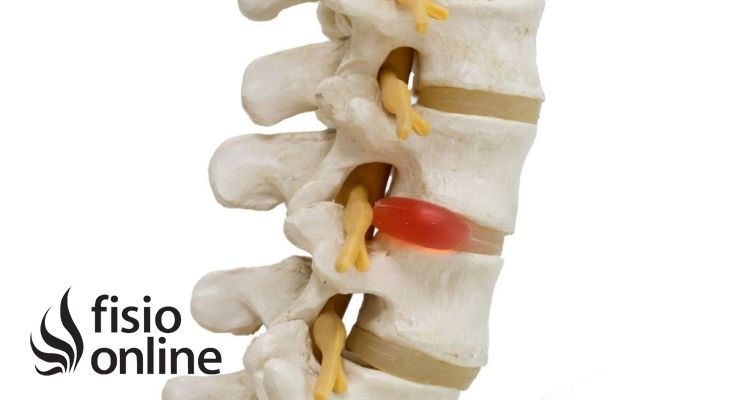 Causas, diagnóstico y tratamiento integrativo para la hernia discal lumbar 