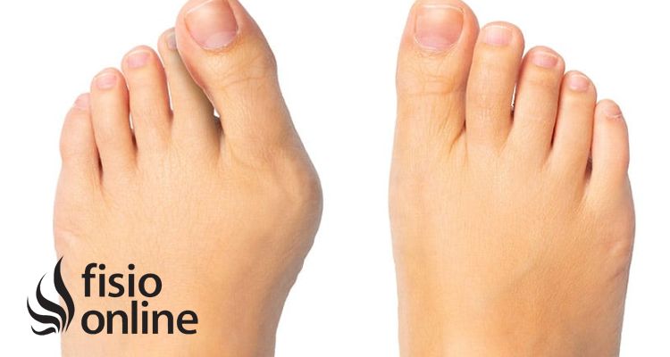 Cómo tratar el Hallux Valgus o Juanete: ejercicios, automasajes y vendaje