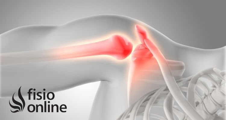 Bursitis, Tendinitis y Síndrome Subacromial: ¿Cómo Diferenciarlos y Tratarlos Correctamente?