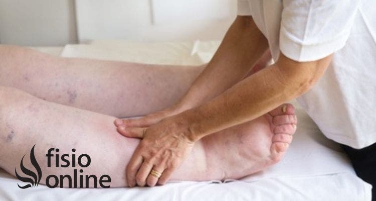 Qué es el Linfedema: desde el diagnóstico hasta el tratamiento 