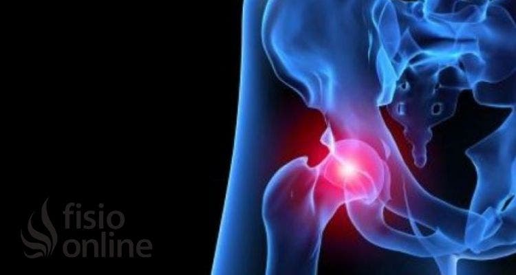 ¿Cuáles son las claves que permiten el diagnóstico del pinzamiento femoroacetabular?