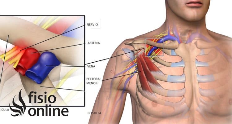 Síndrome del Desfiladero Torácico: qué es, tipos, causas, diagnóstico y tratamiento