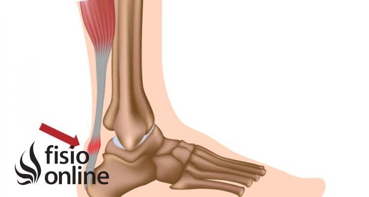 Rotura del tendón de Aquiles. Causas, síntomas y tratamiento