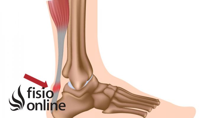fisura causas sintomas y tratamiento