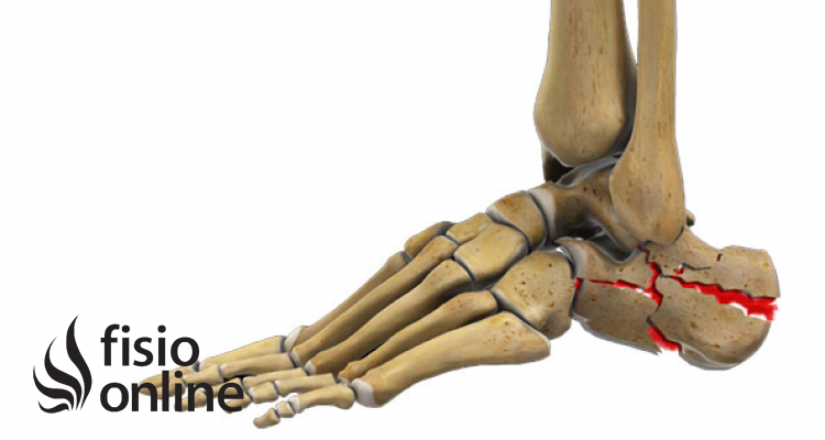 Fracturas del calcáneo: ¿Cuáles son los tipos de fracturas de calcáneo?