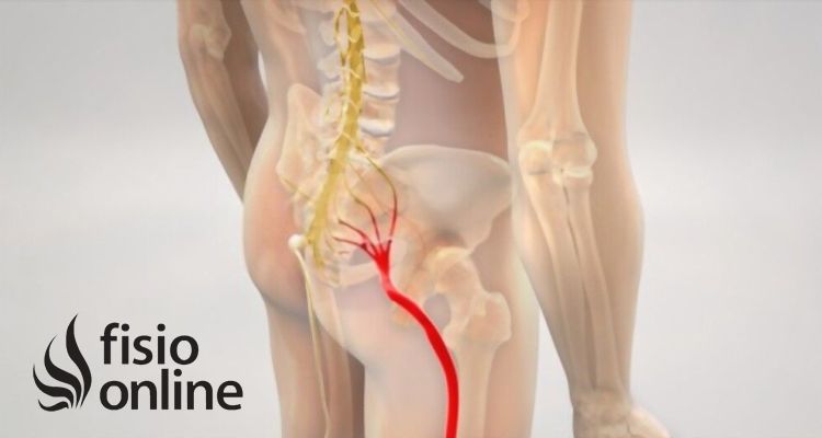 Tratamiento integrativo y natural para el dolor de ciática: todo lo que necesitas saber