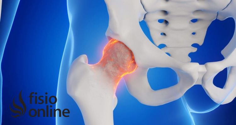 Trocanteritis persistente: el glúteo medio débil como causa ignorada del dolor lateral de cadera