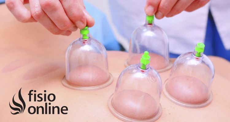 Que es el Cupping Therapy Ventosas para que sirve y como funciona FisioOnline