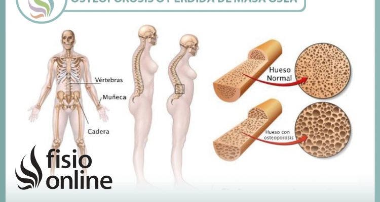 La osteoporosis o pérdida de masa ósea. Un grave problema de los huesos