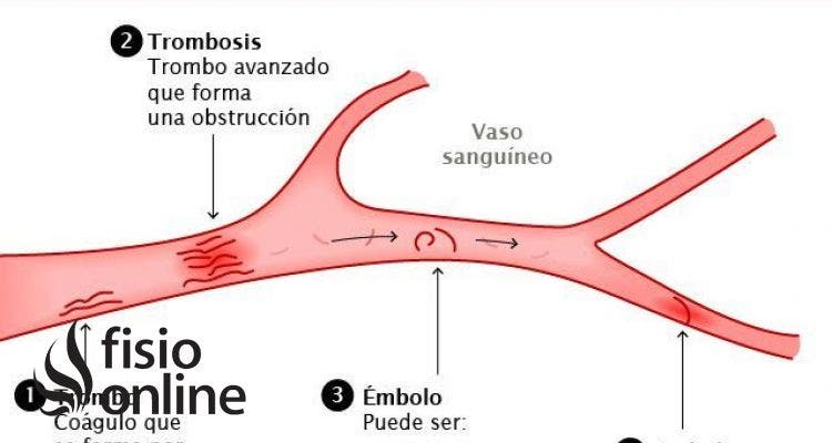 Trombosis o embolia