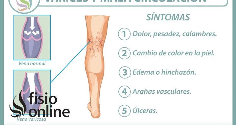 Varices, el castigo de la circulación